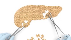 Cirugía vs diabetes ¿se puede?