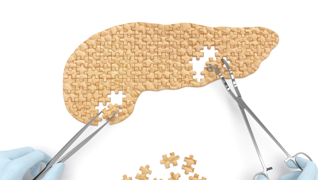 Cirugía vs diabetes ¿se puede?
