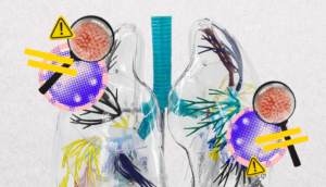 Cáncer de pulmón: Todo lo que tienes que saber