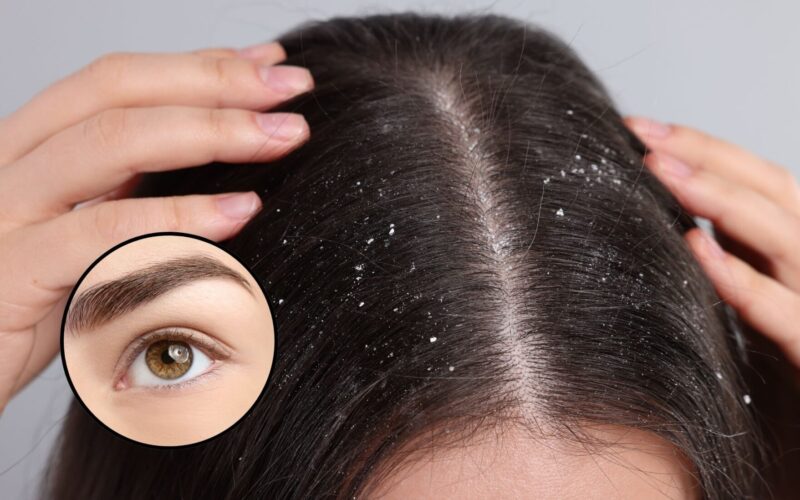 ¿Caspa en las cejas? ¿Cómo quitarla sin dejar marcas?