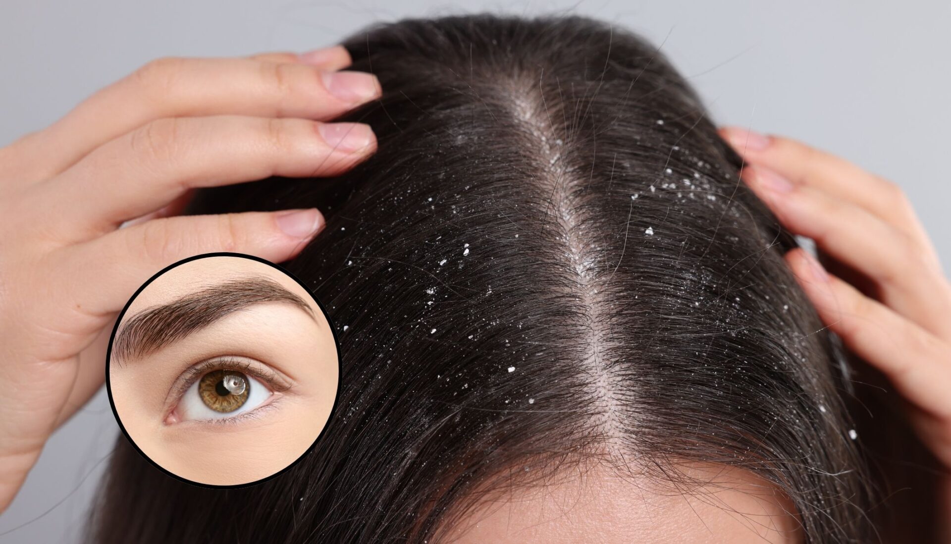 ¿Caspa en las cejas? ¿Cómo quitarla sin dejar marcas?