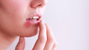 ¿La herpes zóster da por estrés? Todo pa’ combatirla
