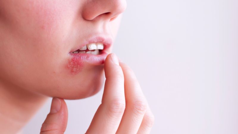 ¿La herpes zóster da por estrés? Todo pa’ combatirla