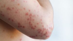 ¿Menos de 50? Necesitas vacunarte de nuevo contra el sarampión